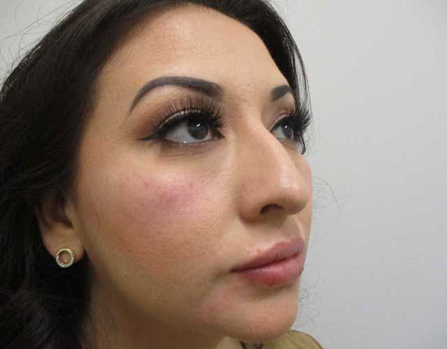 Cheeks Before & After