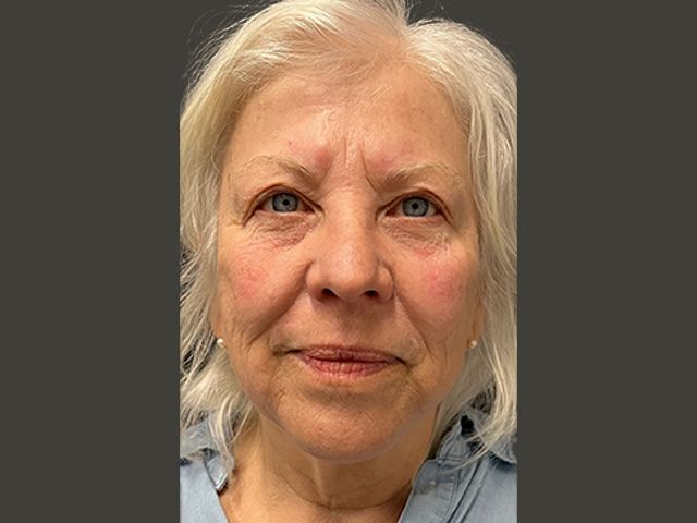 Cheeks Before & After