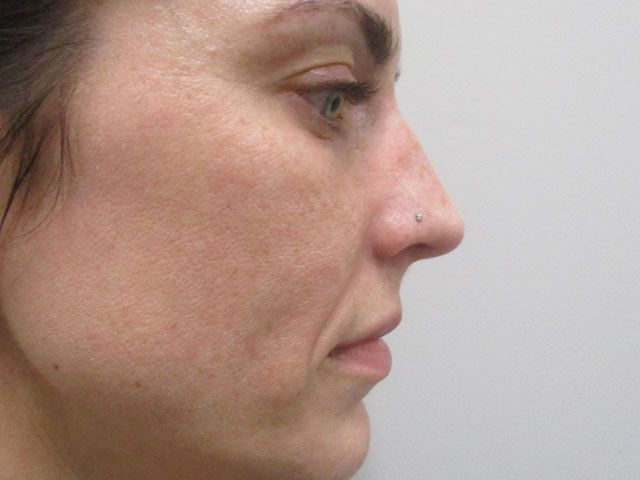 Cheeks Before & After