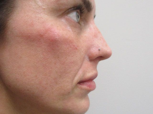 Cheeks Before & After