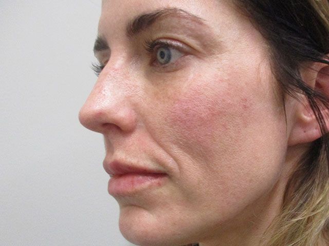 Cheeks Before & After