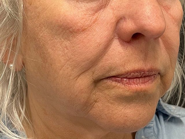 Cheeks Before & After