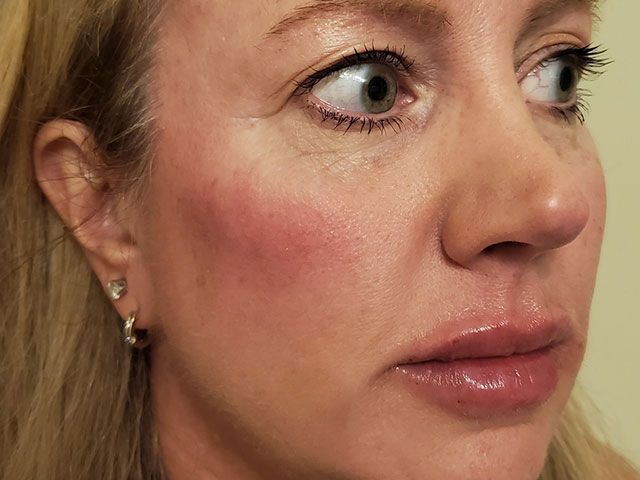 Cheeks Before & After