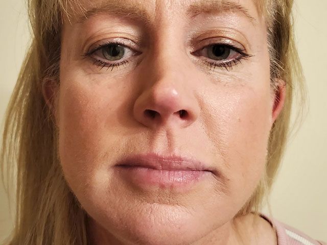 Cheeks Before & After