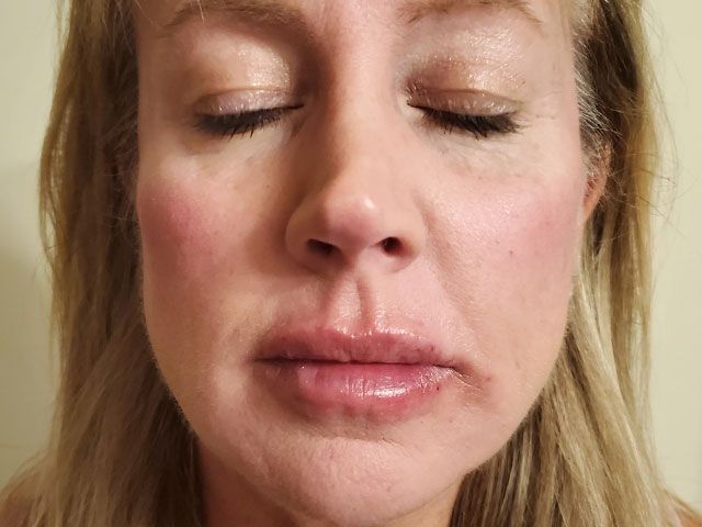 Cheeks Before & After