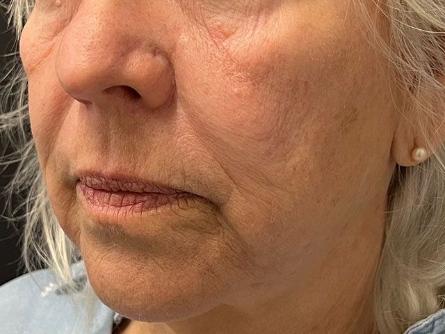 Cheeks Before & After