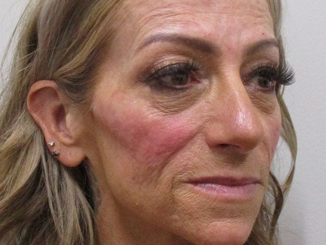 Cheeks Before & After