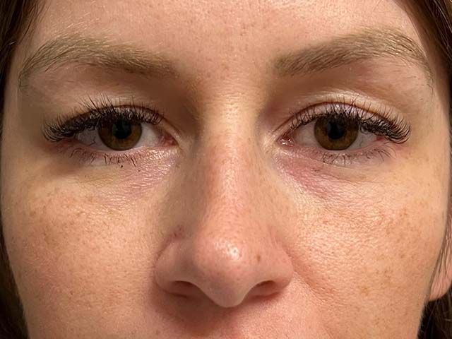 Cheeks Before & After