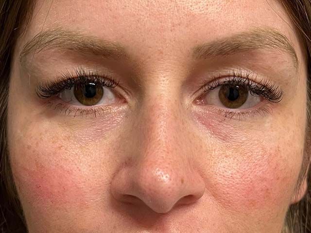 Cheeks Before & After