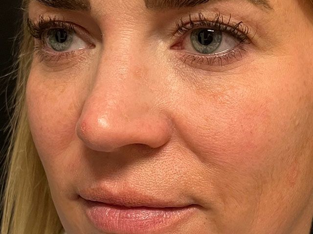 Cheeks Before & After