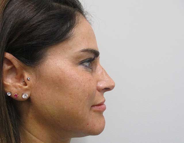 Cheeks Before & After