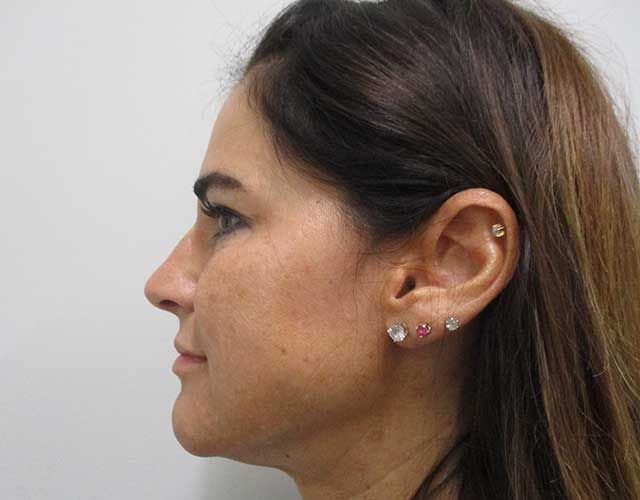 Cheeks Before & After