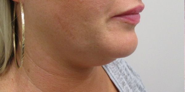 Kybella Before & After