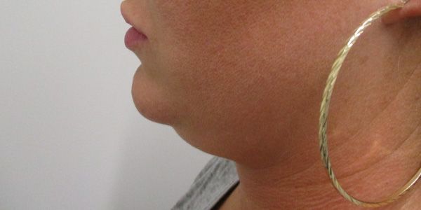 Kybella Before & After