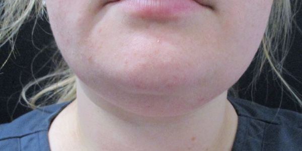 Kybella Before & After