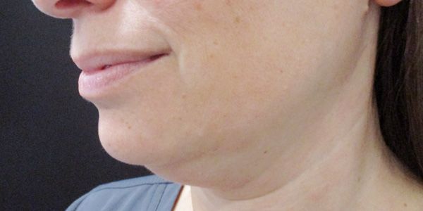 Kybella Before & After