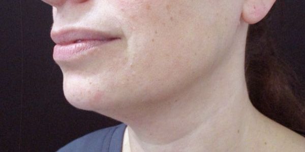 Kybella Before & After