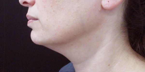 Kybella Before & After