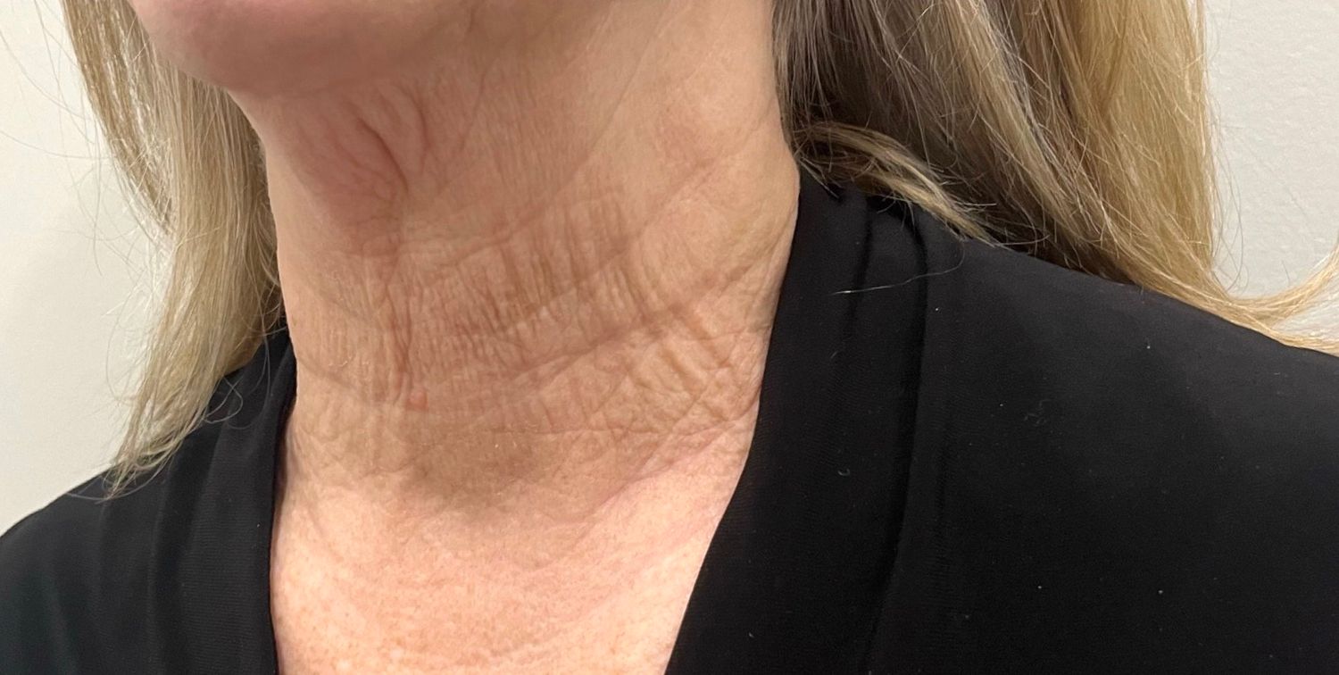 Kybella | Liquid Lipo Before & After