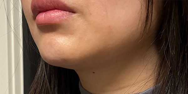 Kybella Before & After