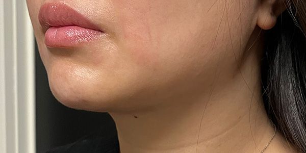 Kybella Before & After