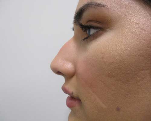 Liquid Rhinoplasty Before & After