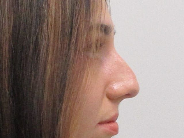 Liquid Rhinoplasty Before & After