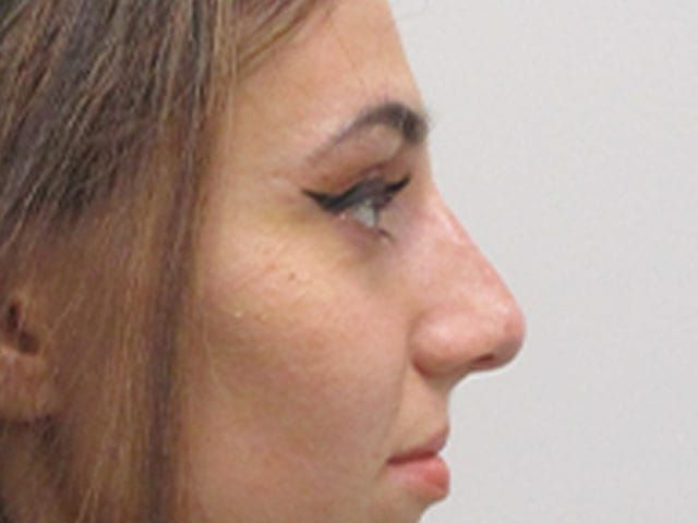Liquid Rhinoplasty Before & After