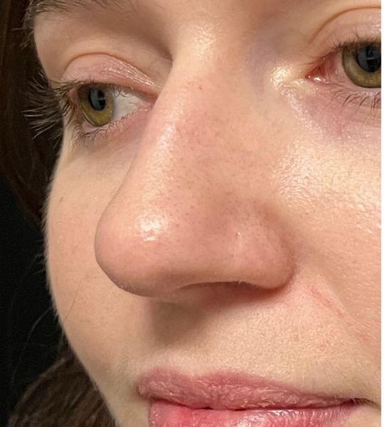 Liquid Rhinoplasty Before & After