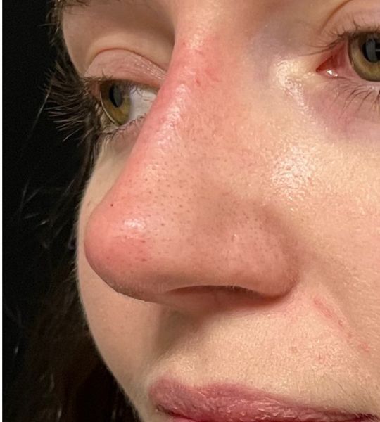 Liquid Rhinoplasty Before & After