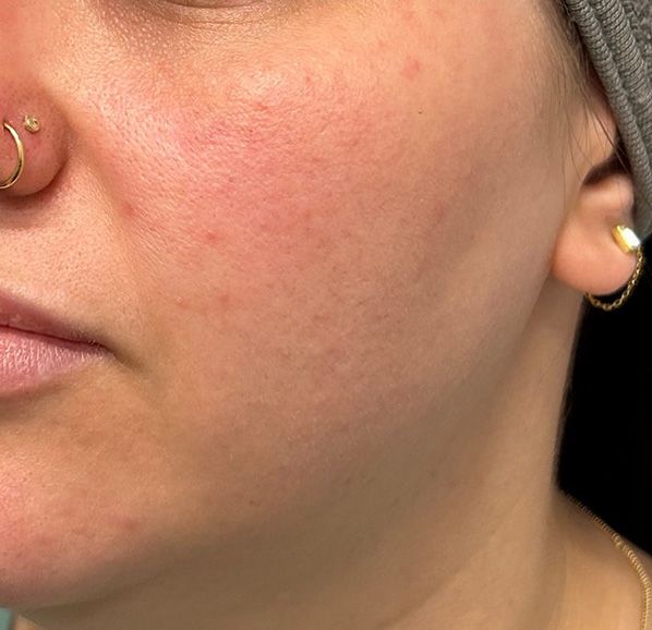 GloTox Infusion Before & After