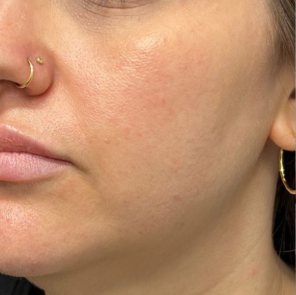 GloTox Infusion Before & After