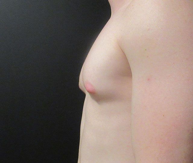 Male Breast Reduction Before & After
