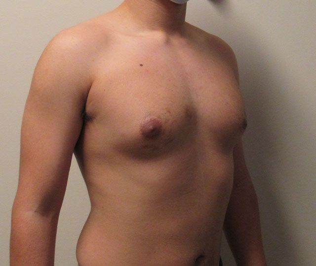Male Breast Reduction Before & After