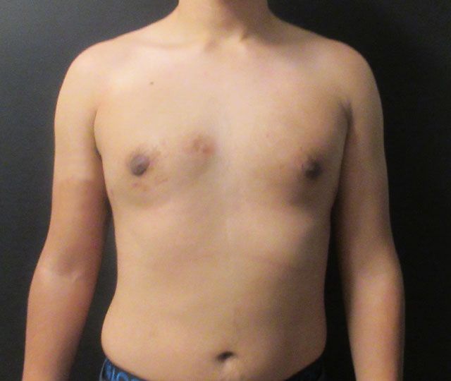 Male Breast Reduction Before & After