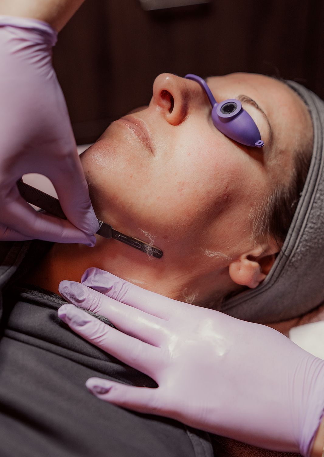 indianapolis dermaplaning patient receiving treatment