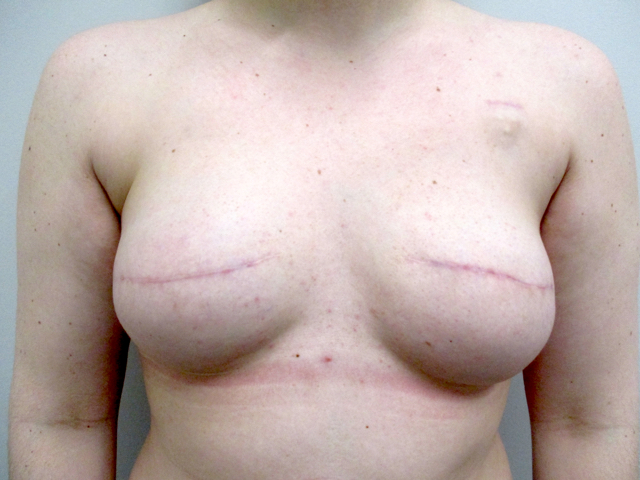 after photo of breasts after breast reconstruction in Indianapolis