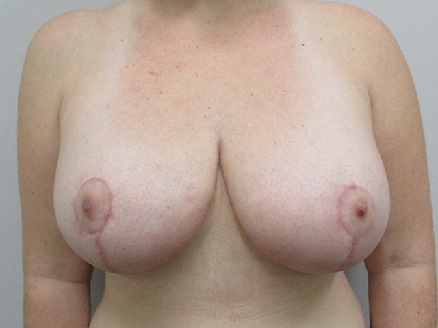 Photo of breasts after breast reduction in Indianapolis