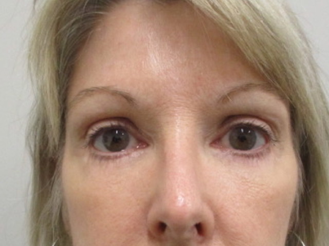 woman after blepharoplasty indianapolis