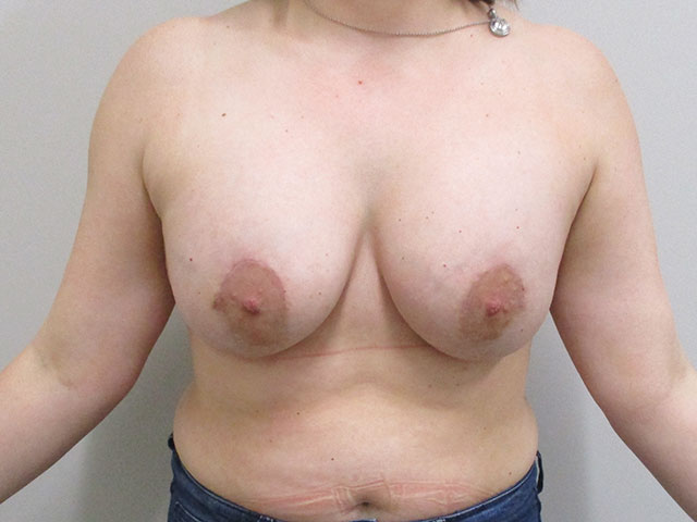 patient after breast lift indianapolis