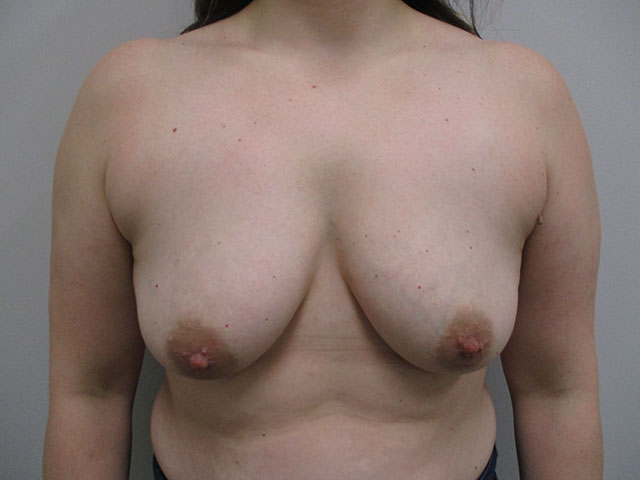 patient before breast lift indianapolis