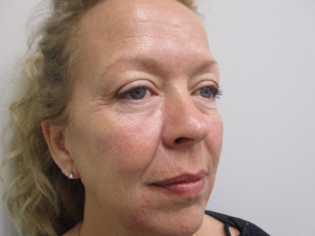 after picture of a nonsurgical facelift indianapolis