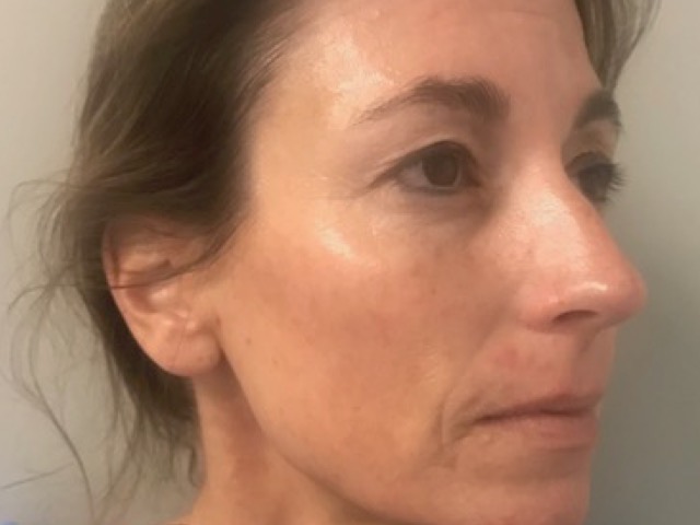 patient after microneedling in Indianapolis.