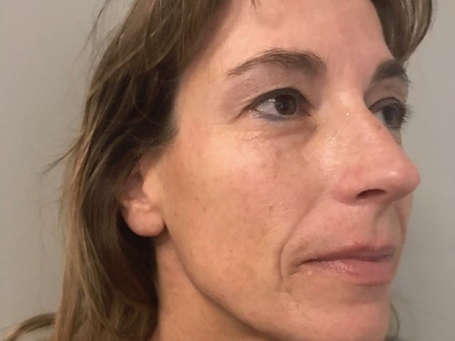 patient before microneedling in Indianapolis.