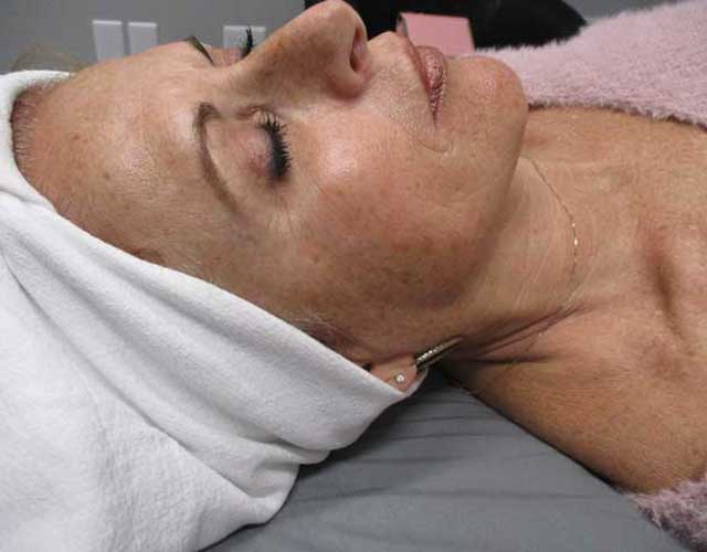 woman before age spot treatment in Indianapolis