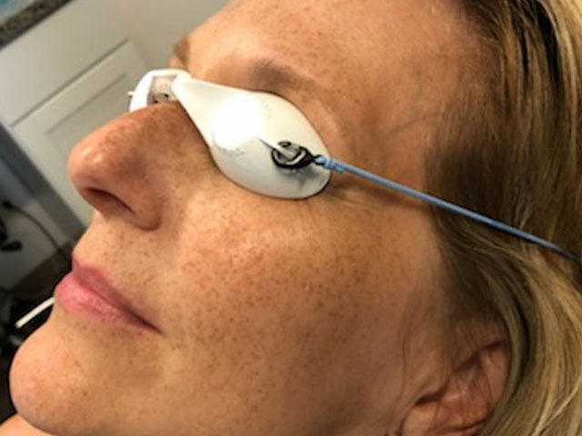 woman's skin with spots before age spot treatment in Indianapolis.