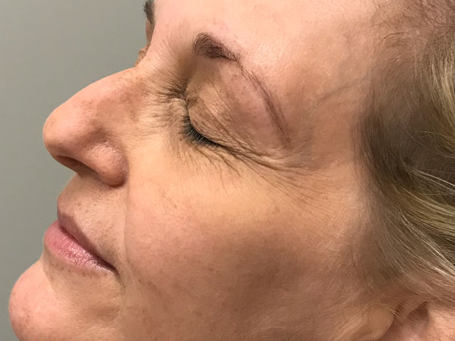 Woman with even skin after age spot treatment in Indianapolis.