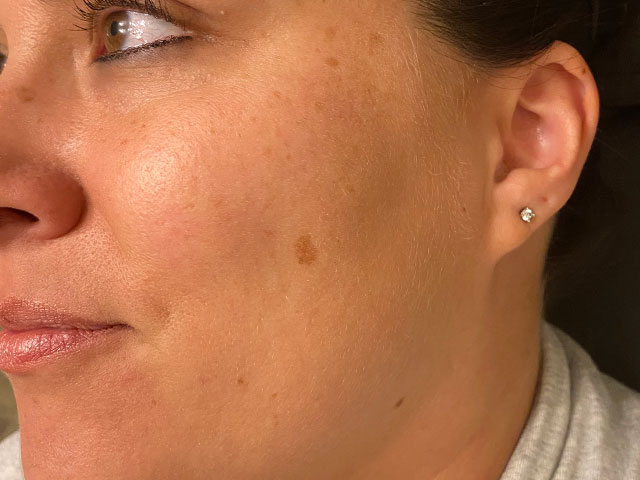 patient before age spot treatment in Indianapolis