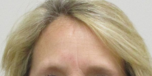 woman's forehead after botox in Indianapolis