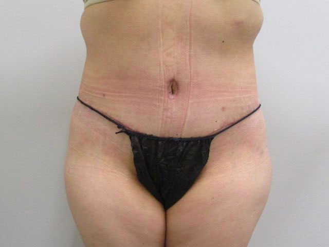 after shot of tummy tuck indianapolis